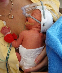 preemie cpap to cannula